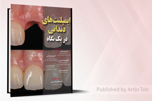 ایمپلنت های دندانی در یک نگاه